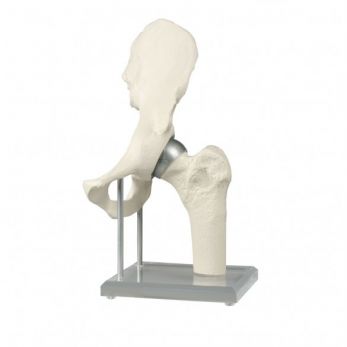 Hip Joint Model with Resurfacing Implant